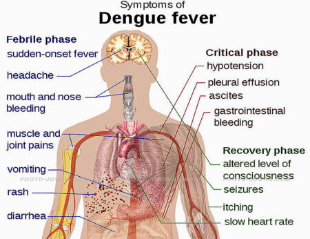 Symptoms of dengue fever