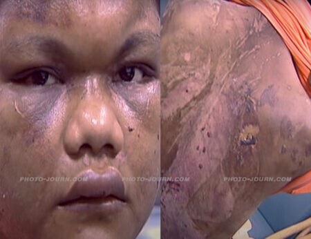 Photos of the horrendous injuries Nirmala Bonat suffered from her Malaysian employer Yim Pek Ha