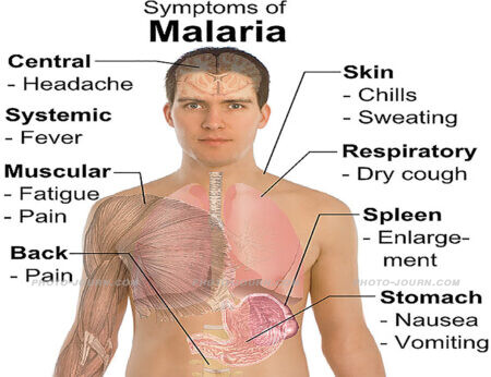 Symptoms of malaria